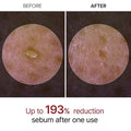 Before and after images showing skin with reduced sebum after using ForKumi rice enzyme exfoliator once